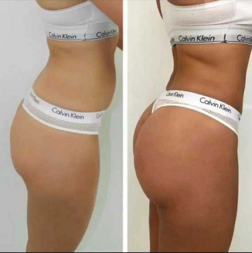 Before and After - Butt Lifting